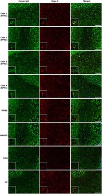 Serum Anti-oligodendrocyte Autoantibodies in Patients With Multiple Sclerosis Detected by a Tissue-Based Immunofluorescence Assay